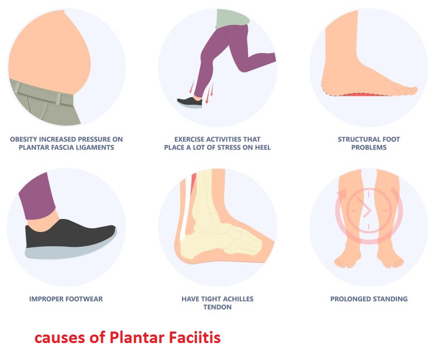 Causes and Treatments for Plantar Fasciitis