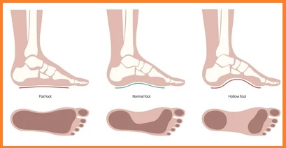 flat normal hollow foot