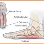 what-is-Plantar-Faciiti