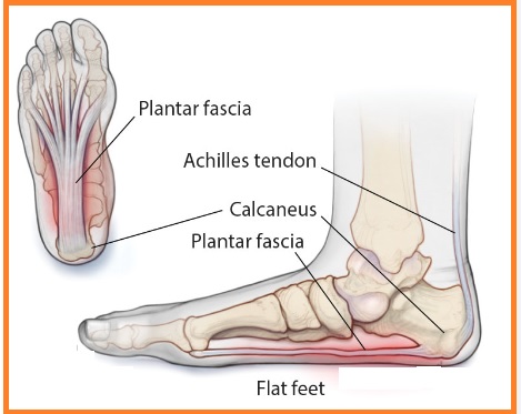 what is Plantar Faciitis